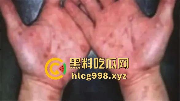 梅毒像疯狗一样乱咬!日本疫情横扫全球,日本卫生部出狠招断根大法安排上,管不住下半身只能禁爱?-12