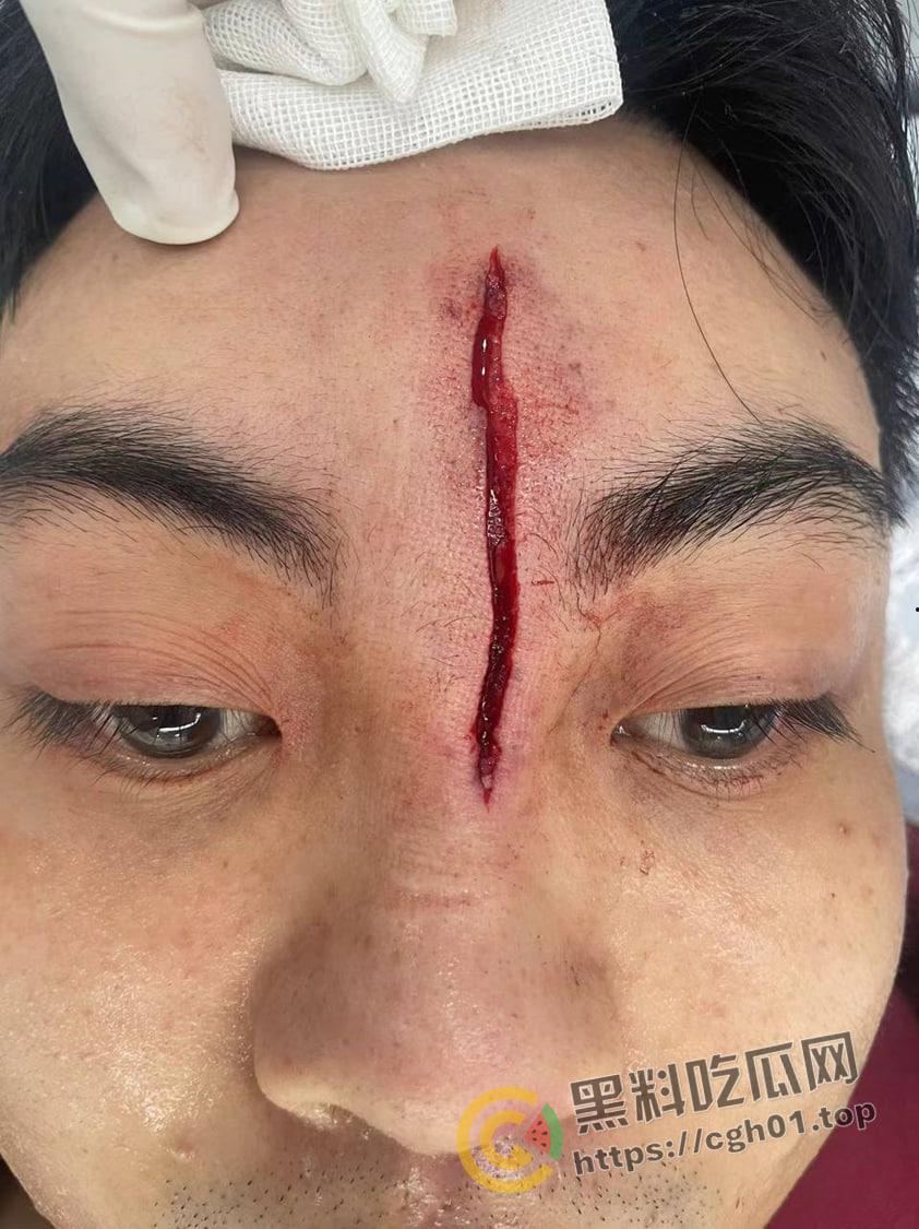 一场野球挣了66w!广州汇悦台野球场暴躁男【王帅】打球带肘给人开瓢 赔66w才能免坐牢-3